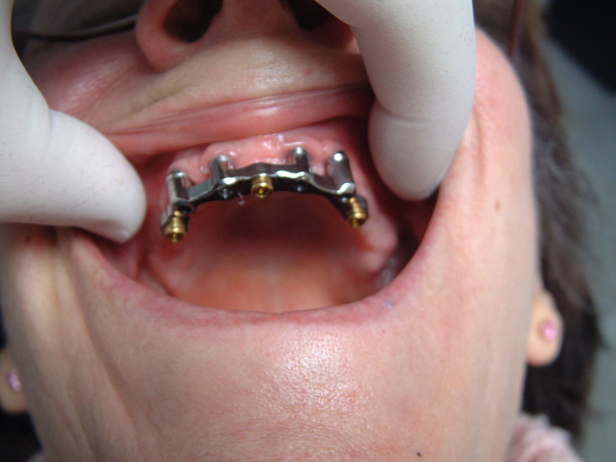 Implant dentaire : combien de types existe-t-il ?