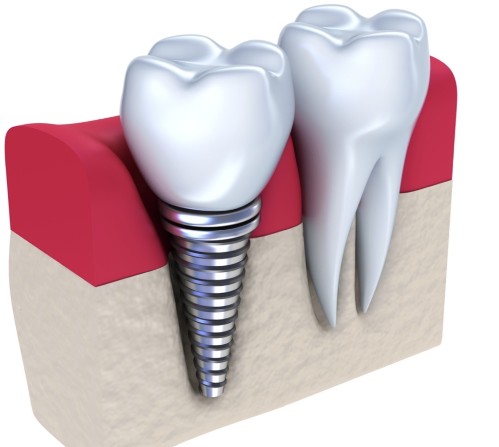 Implant dentaire : Pourquoi privilégier l’opération ?